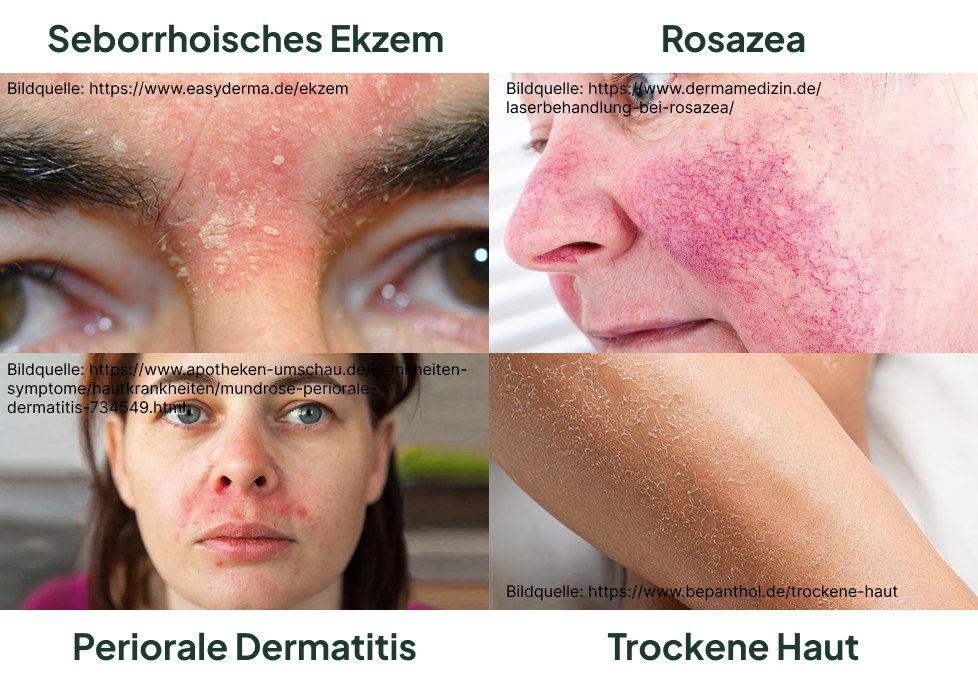 Vier Vergleichsfotos: seborrhoisches Ekzem mit gelblichen Schuppen an Augenbrauen und Stirn; Rosazea mit flächiger Wangenrötung und sichtbaren Äderchen; periorale Dermatitis mit kleinen roten Papeln um Nase und Mund; trockene Haut mit feinen weißen Schüppchen